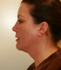 Feel Beautiful - Neck Liposuction San Diego Case 16 - Before Photo